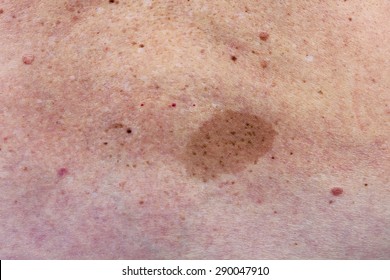 Age Spots Skin Images Stock Photos Vectors Shutterstock