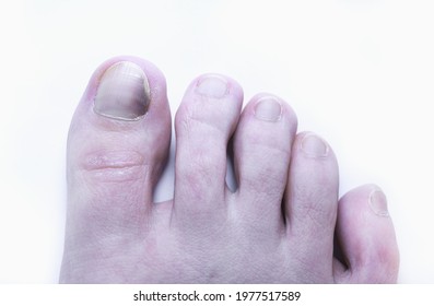 gomba nail foot processing cipő a köröm gombás gyógymód a lábakon