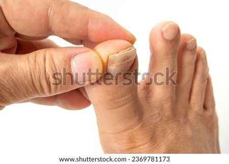 Big toe cracked by toenail fungus