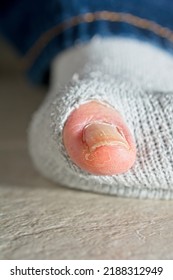 Big Toe, The Hallux, Extended Out Of Hole In Sock. Low-angle View With Pant Leg In Background On Beige Ceramic Tile Floor, Selective Focus