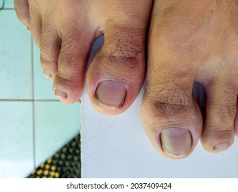 Big Toe With Long Toenails And Unclean Toenails