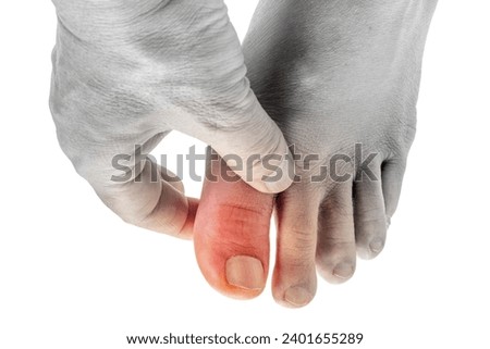 Big toe of a man with gout