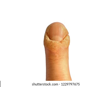 Wart Nail Hd Stock Images Shutterstock