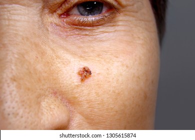 Human papillomavirus facial warts - Hpv virus facial warts
