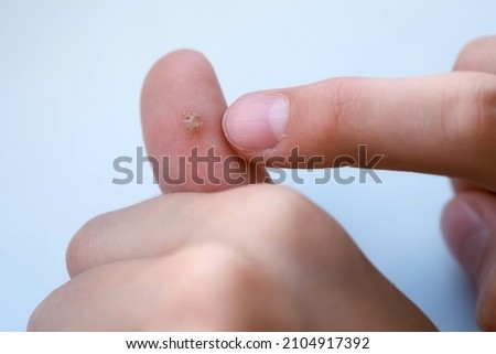 Big wart, verruca on human thumb finger before laser removing on grey backgroung, closeup view. Human papillomavirus, weakened immunity, treatment of warts. Doctor is touching boy's finger.