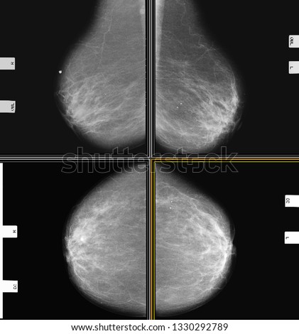 Bilateral Full Digital Mammography MLO and CC View (High Resolution)
