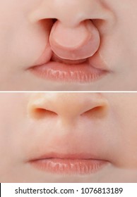 Bilateral Lip And Palate Cleft Before And After Surgery, Corecting The Birth Defect.