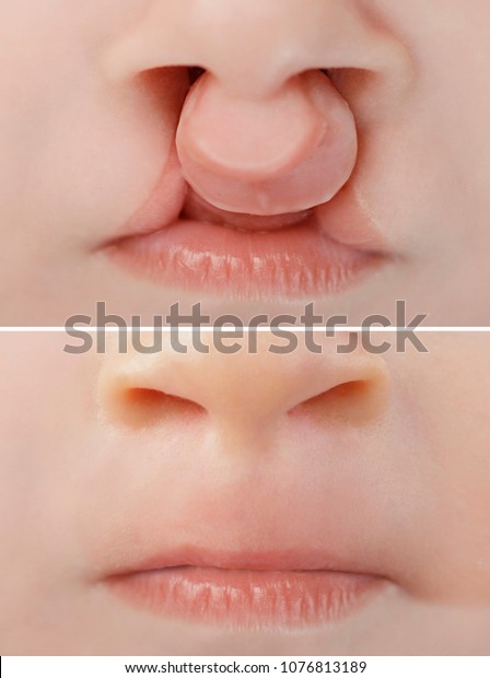 Bilateral lip and palate cleft before and after\
surgery, corecting the birth\
defect.