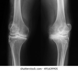 Bilateral osteoarthritis knee joint x-ray image, anteroposterior (AP) view