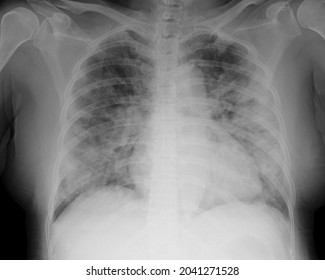 Bilateral Pneumonia Covid 19 Chest Xray