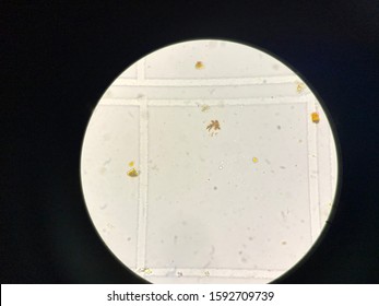 Bilirubin Crystal In Urine Analysis