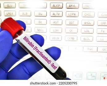 Bilirubin (Fractionated) Direct Blood Test. To Measuring The Levels Of Bilirubin Is Used In The Diagnosis And Treatment Of Liver, Hemolytic, Hematologic, And Metabolic Disease.