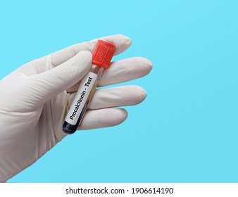 Biochemist Or Doctor Holds Blood Sample For Procalcitonin (PCT) Test, Diagnosis Of Severe Sepsis Test. Medical Testing Concept.