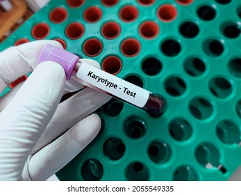 Biochemist or doctor holds blood sample for karyotype test, abnormal chromosome, to identify and evaluate the size, shape, and number of chromosomes.
