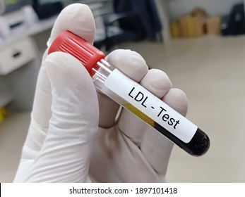 Biochemist or Lab Technologist holds Blood sample for LDL (low-density lipoprotein) test. Lipid profile. Bad Cholesterol Medical testing concept.