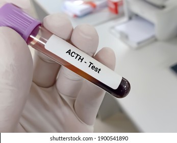 Biochemist or Lab Technologist holds Blood sample for Adrenocorticotropic hormone (ACTH) test, diagnosis of Addison's disease with laboratory background. 