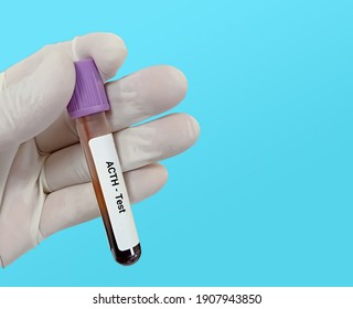 Biochemist or Lab Technologist holds Blood sample for Adrenocorticotropic hormone (ACTH) test, diagnosis of Addison's disease. 