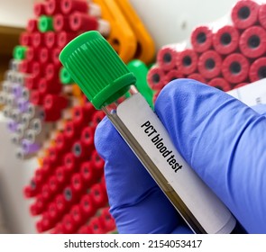 Biochemist Or Lab Technologist Holds Blood Samples For PCT(Procalcitonin) Test, Diagnosis Of Severe Sepsis.