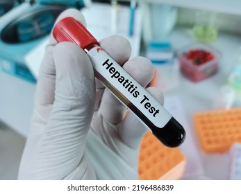 Biochemist Of Scientist Holds Blood Sample For Hepatitis A, B, C Virus Test In Laboratory Background.