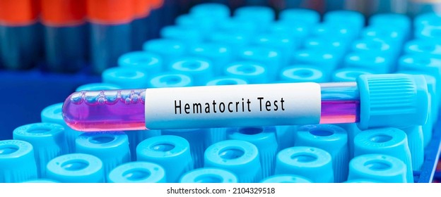 Biochemistry Blood Sample For Hematocrit, HTC, MCV Test