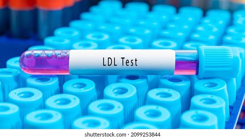 Biochemistry Blood Sample For LDL  Low-density Lipoprotein Test