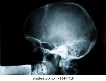 Bionic Man Profile on X-Ray on black background.