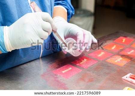 Biopsy samples being processed at the pathology laboratory to be embedded in paraffin for analysis. Cancer diagnosis concept. Medical concept.