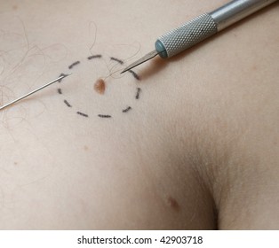 Birth Mark With Aerosolum And Scalpel