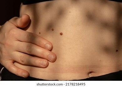 Birthmarks on skin Close up detail of the bare skin Sun Exposure effect on skin, Health Effects of UV Radiation Woman with birthmarks Pigmentation and lot of birthmarks. - Shutterstock ID 2178218495