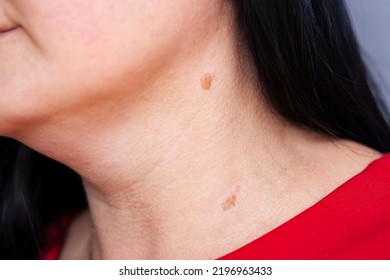 Birthmarks On Skin Close Up Detail Of The Bare Skin Sun Exposure Effect On Skin, Health Effects Of UV Radiation Woman With Birthmarks Pigmentation And Lot Of Birthmarks.