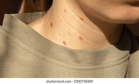 Birthmarks On Skin Close Up Detail Of The Bare Skin Sun Exposure Effect On Skin, Health Effects Of UV Radiation Woman With Birthmarks Pigmentation And Lot Of Birthmarks.