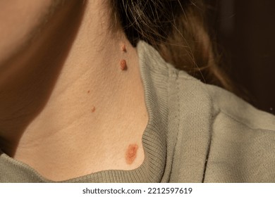 Birthmarks On Skin Close Up Detail Of The Bare Skin Sun Exposure Effect On Skin, Health Effects Of UV Radiation Woman With Birthmarks Pigmentation And Lot Of Birthmarks.