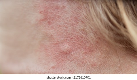 Bite Mark, Sting Or Sore On Human Skin. Close Up Of Symptoms. Healthcare Theme.