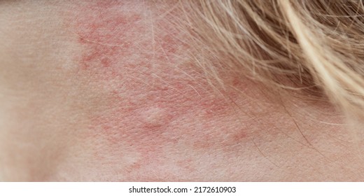 Bite Mark, Sting Or Sore On Human Skin. Close Up Of Symptoms. Healthcare Theme.