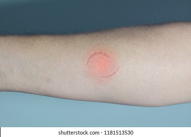Bite marks on the arm.