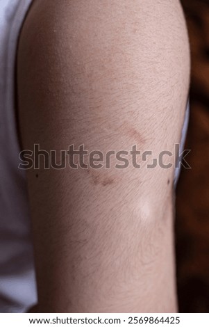 Bite marks pattern bruise on a young boys arm, bullying aggressive behavior concept, soft focus close up 