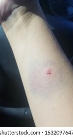 Bite On Arm Showing Bruising