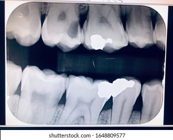 Bitewing dental x-ray show teeth roots, gum disease and tooth decay to enamel. Radiographs play an integral part in assessment and diagnosis of periodontal infection,gum disease,dental caries,cavities