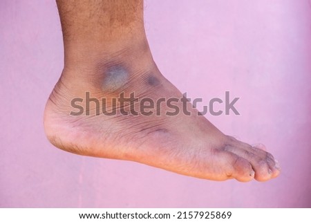 black ankles caused by shoe friction