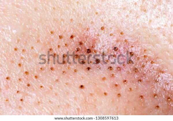 black-dots-on-skin-blocked-ducts-stock-photo-edit-now-1308597613