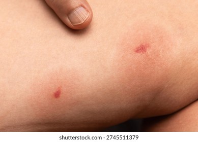 Black fly bite marks on the woman leg.