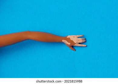 Black Girl Doll Hold Hand With Viteligo On Blue Background