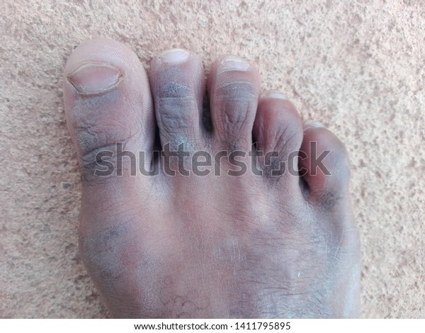 black dead skin on foot