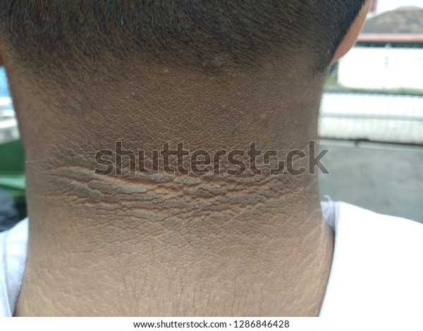 Black Marks Of The Skin Around The Neck Of Overweight Children Is One