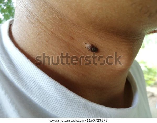 Black Mole On Neck Skinmelanoma Stock Photo Edit Now 1160723893 They are usually round or have a regular shape. https www shutterstock com image photo black mole on neck skinmelanoma 1160723893