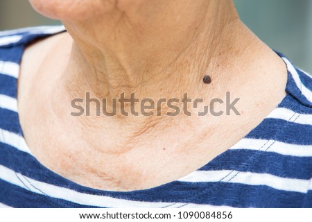 Black mole on senior woman's neck, Medicine, Close up