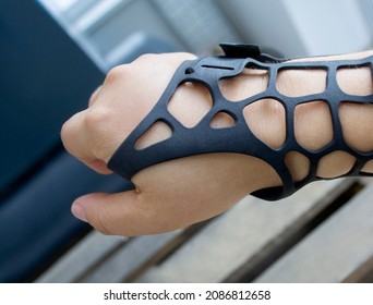 Black Orthopedic Plastic Prosthesis Printed On Powder 3D Printer On Hand. Orthopedic Gypsum Is On Arm Close-up.