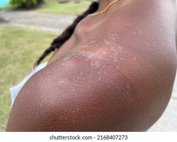 A Black Person With Peeling Skin After Suntanning Too Much