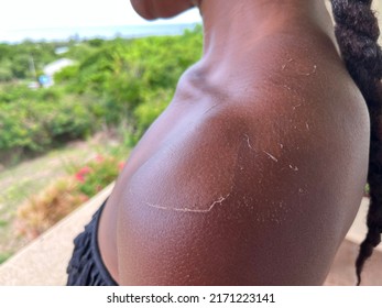 A Black Person With Peeling Skin After Suntanning Too Much