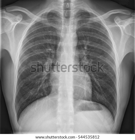 Black and white medical radiography of thorax